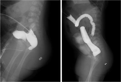 Laparoscopic-assisted distal colon excision and proximal colon pull-through anorectoplasty for anorectal malformation